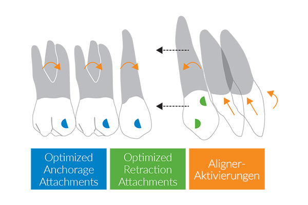 Activaciones en los aligners