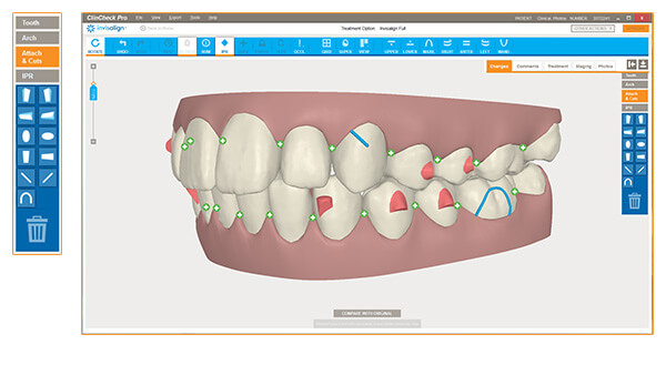 Image result for invisalign clincheck